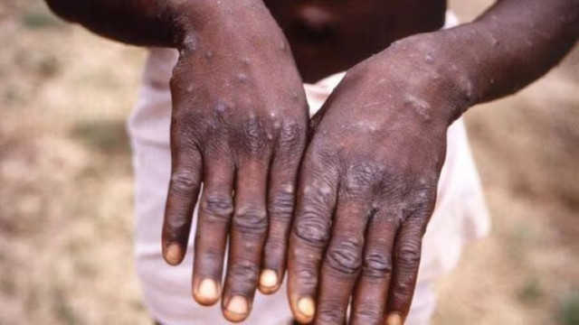 Tally hits 95 as two more monkeypox cases reported in Sindh